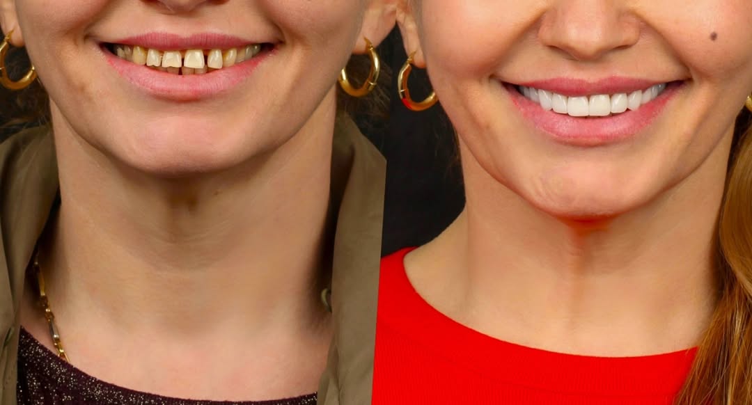 change your smile #zirkonyum #dentaltechnician #dentalclinic #dentistry #natural #teeth #beaut