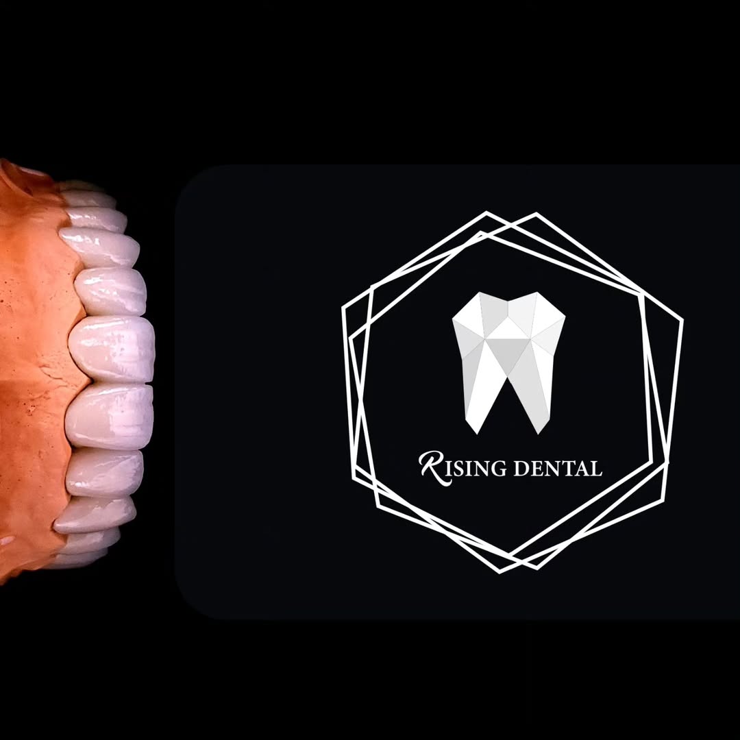 #metalceramic #dentistry #dentallaboratory #dentaltecnician #risingdental #porcelain #noritake